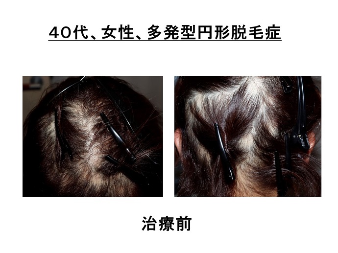 円形脱毛症　病院